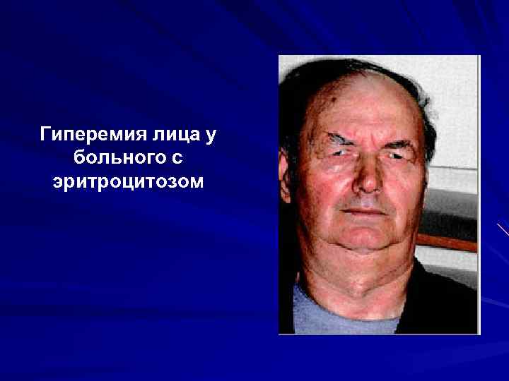 Гиперемия лица у больного с эритроцитозом 