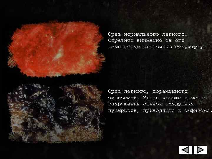 Срез нормального легкого.  Обратите внимание на его компактную клеточную структуру. Срез легкого, пораженного