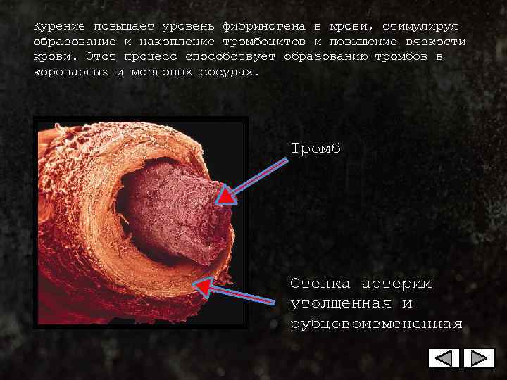 Курение повышает уровень фибриногена в крови, стимулируя образование и накопление тромбоцитов и повышение вязкости