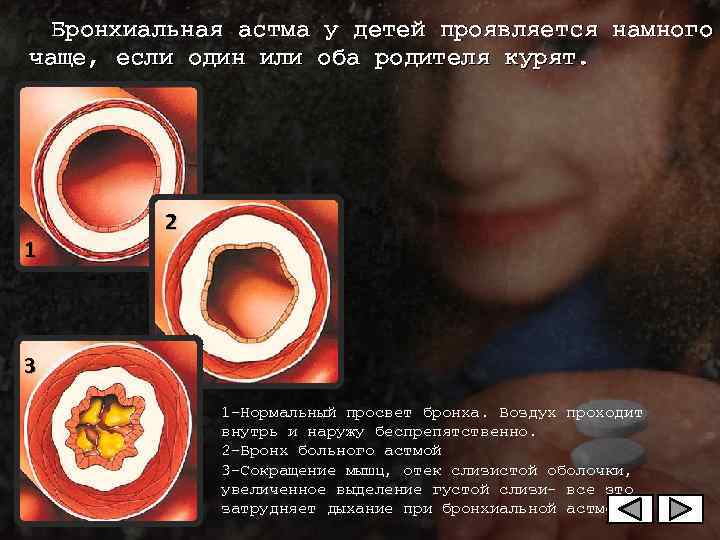  Бронхиальная астма у детей проявляется намного чаще, если один или оба родителя курят.