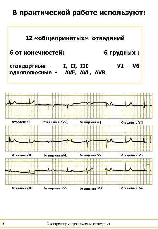   В практической работе используют:  12 «общепринятых» отведений 6 от конечностей: 