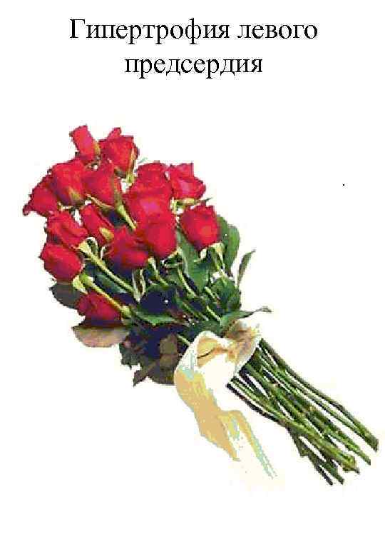 Гипертрофия левого предсердия 