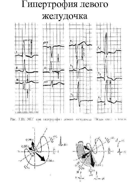 Гипертрофия левого желудочка 