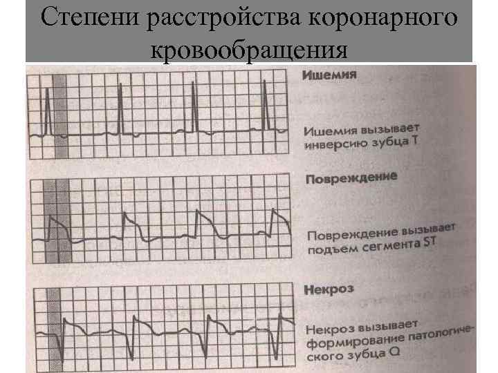 Степени расстройства коронарного   кровообращения 
