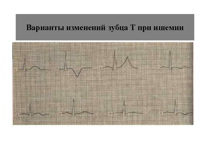 Варианты изменений зубца Т при ишемии 