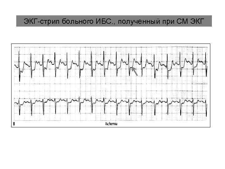 ЭКГ-стрип больного ИБС. , полученный при СМ ЭКГ 