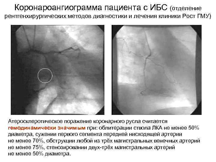   Коронароангиограмма пациента с ИБС (отделение рентгенхирургических методов диагностики и лечения клиники Рост