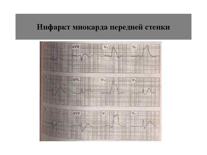 Инфаркт миокарда передней стенки 