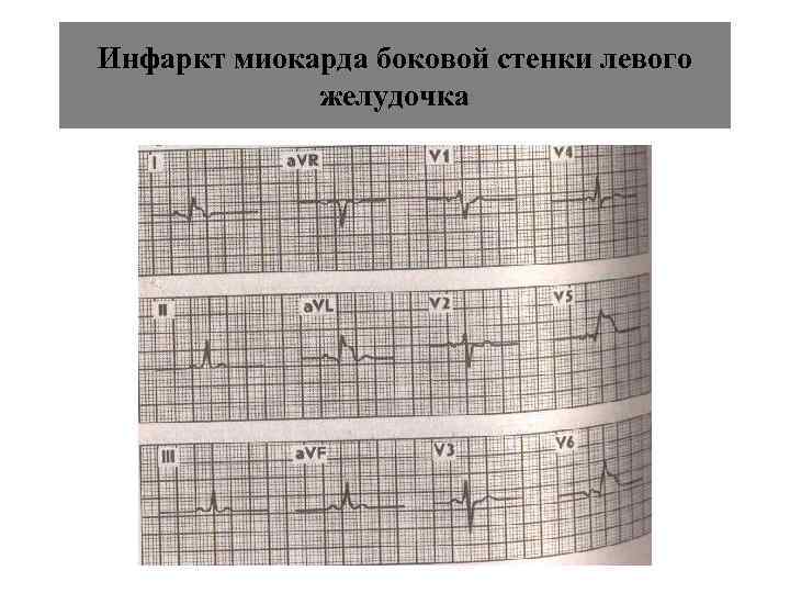 Инфаркт миокарда боковой стенки левого   желудочка 