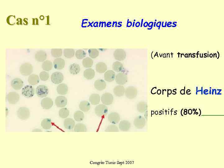Cas n° 1  Examens biologiques    (Avant transfusion)   