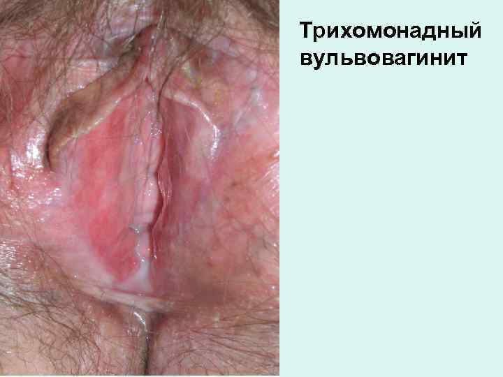 Трихомонадный вульвовагинит 