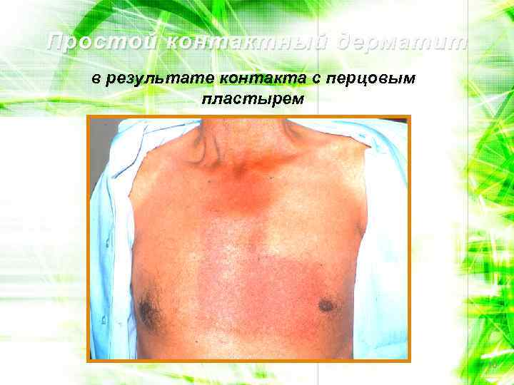 Простой контактный дерматит в результате контакта с перцовым пластырем 10 
