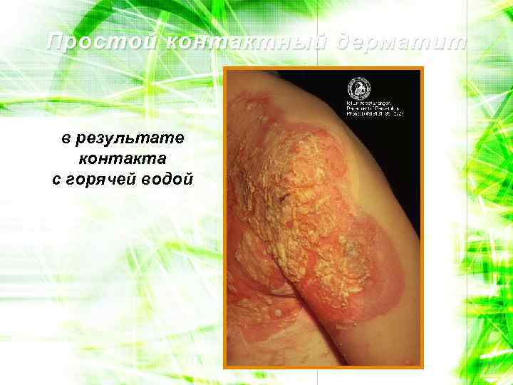 Простой контактный дерматит в результате контакта с горячей водой 11 