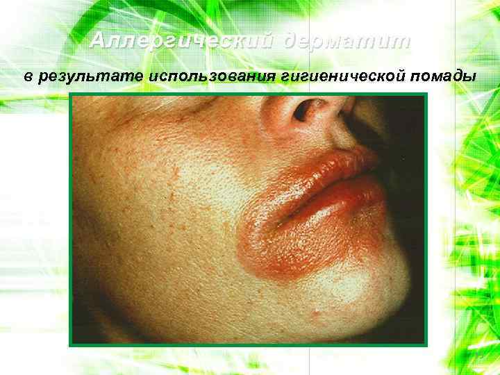 Аллергический дерматит в результате использования гигиенической помады 15 