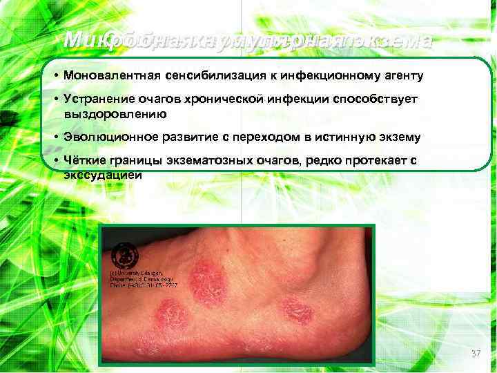 Общие нумулярная экзема Микробнаяхарактеристики микробной ЭКЗЕМЫ • Моновалентная сенсибилизация к инфекционному агенту • Устранение