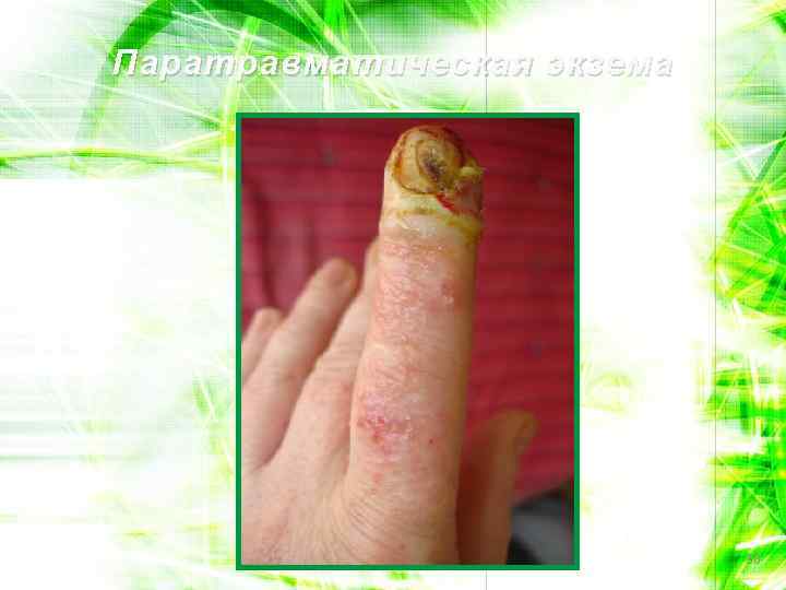 Паратравматическая экзема 38 