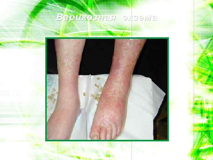 Варикозная экзема 39 