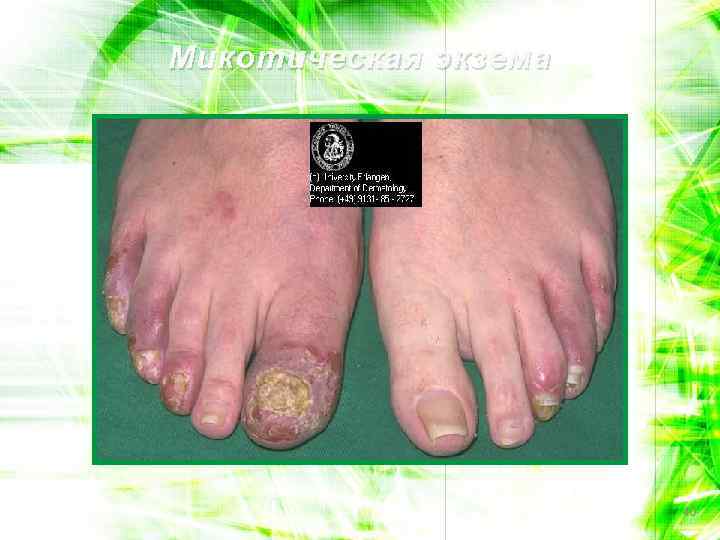 Микотическая экзема 40 