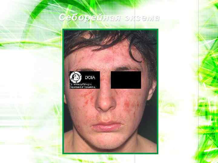 Себорейная экзема 42 