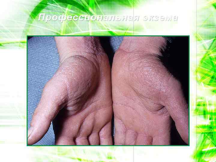 Профессиональная экзема 43 