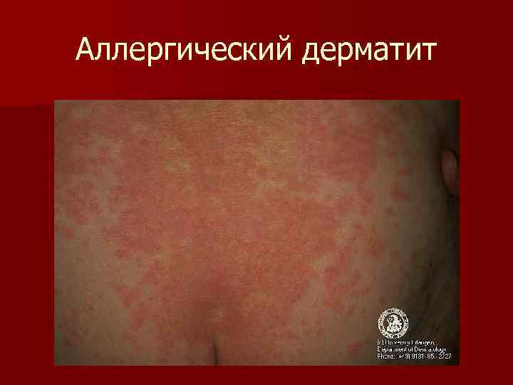 Аллергический дерматит 