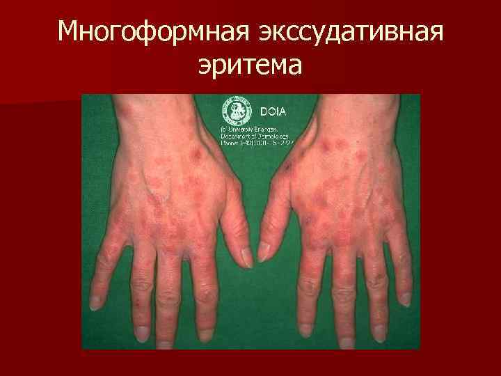 Многоформная экссудативная   эритема 
