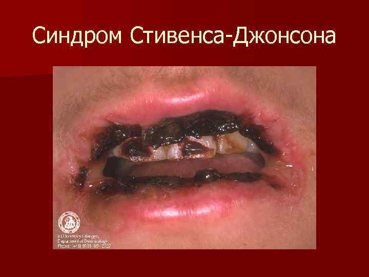 Синдром Стивенса-Джонсона 
