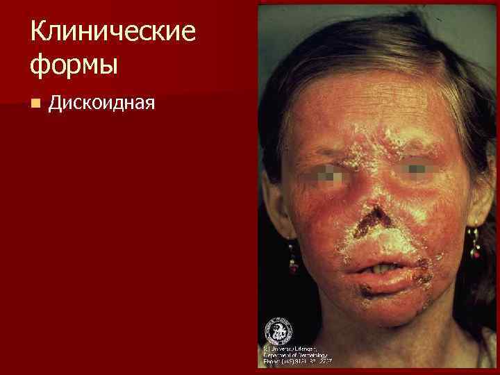 Клинические формы n  Дискоидная 