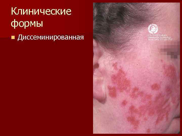 Клинические формы n  Диссеминированная 