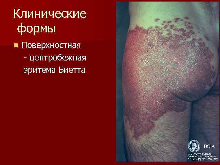 Клинические формы n  Поверхностная - центробежная эритема Биетта 