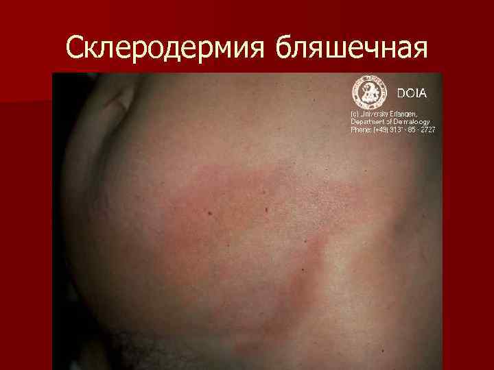 Склеродермия бляшечная 