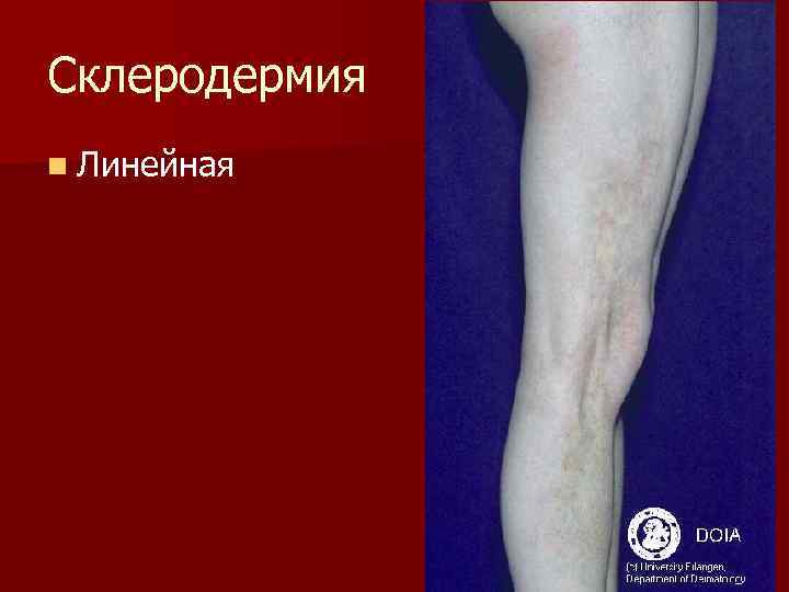 Склеродермия n Линейная 