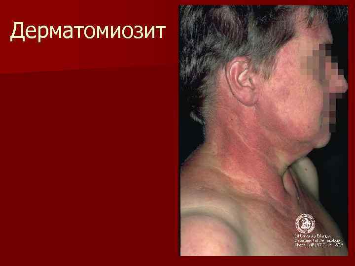 Дерматомиозит 