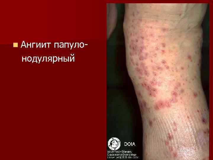 n Ангиит  папуло- нодулярный 