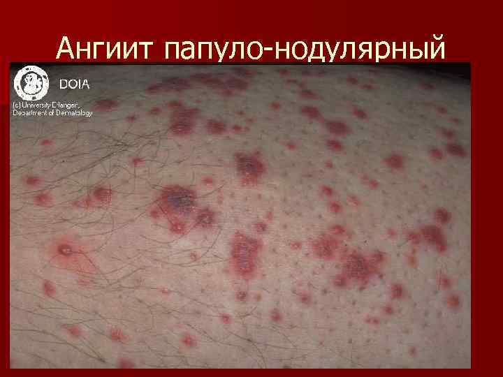 Ангиит папуло-нодулярный 