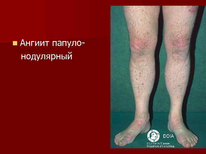 n Ангиит  папуло- нодулярный 