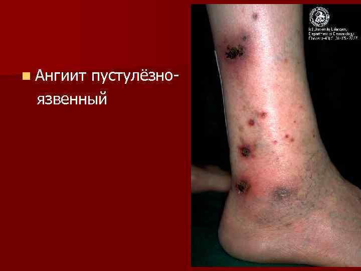 n Ангиит  пустулёзно- язвенный 
