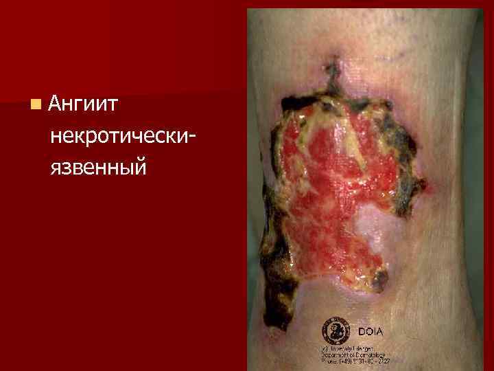 n Ангиит некротически- язвенный 