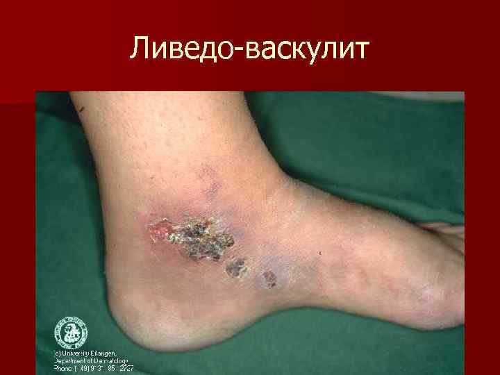 Ливедо-васкулит 