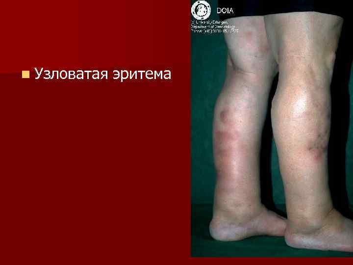 n Узловатая  эритема 