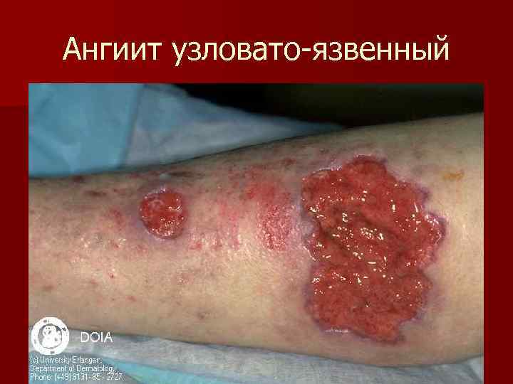 Ангиит узловато-язвенный 