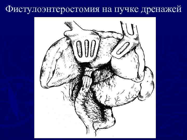 Фистулоэнтеростомия на пучке дренажей 