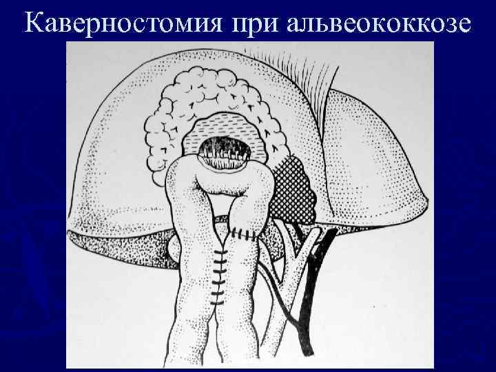 Каверностомия при альвеококкозе 