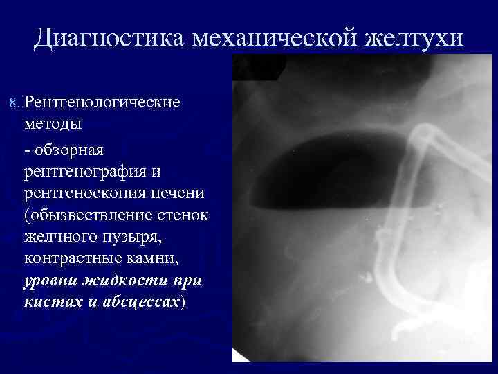 Диагностика механической желтухи 8. Рентгенологические методы - обзорная рентгенография и рентгеноскопия печени (обызвествление стенок