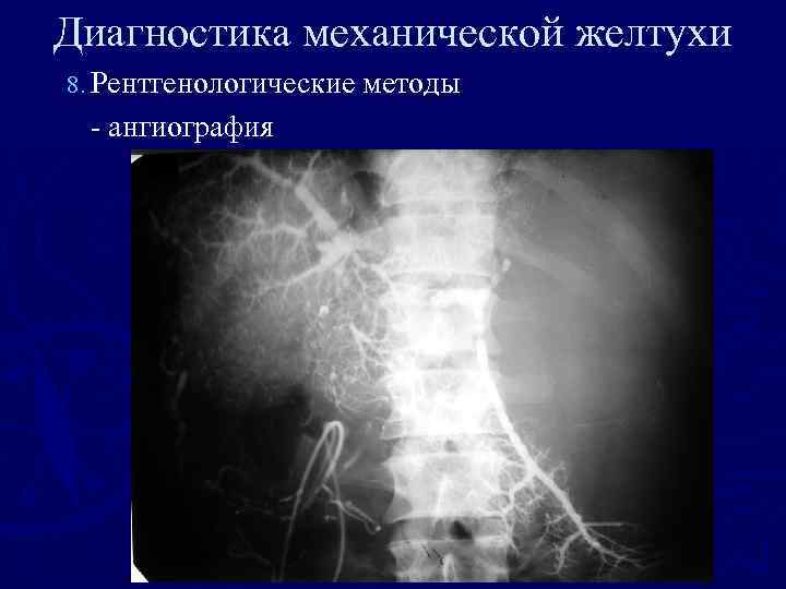 Диагностика механической желтухи 8. Рентгенологические методы - ангиография 