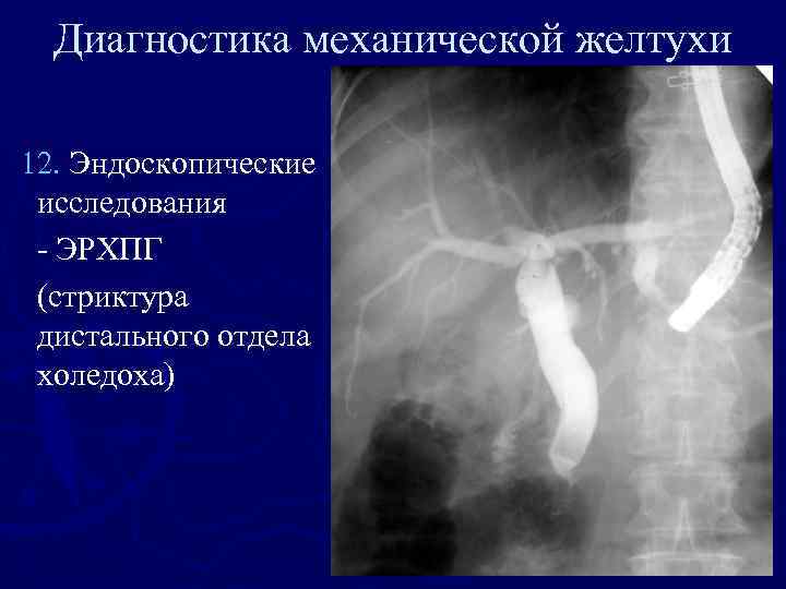 Диагностика механической желтухи 12. Эндоскопические исследования - ЭРХПГ (стриктура дистального отдела холедоха) 
