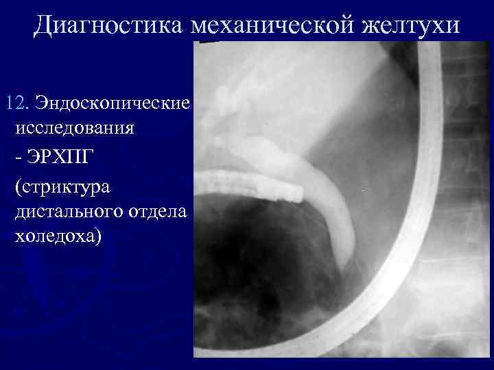 Диагностика механической желтухи 12. Эндоскопические исследования - ЭРХПГ (стриктура дистального отдела холедоха) 