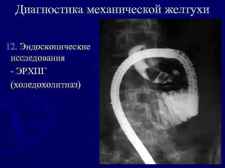 Диагностика механической желтухи 12. Эндоскопические исследования - ЭРХПГ (холедохолитиаз) 