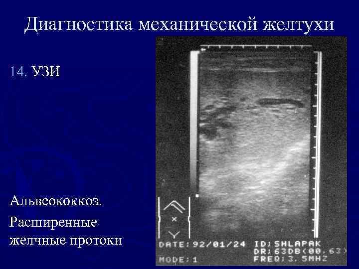Диагностика механической желтухи 14. УЗИ Альвеококкоз. Расширенные желчные протоки 