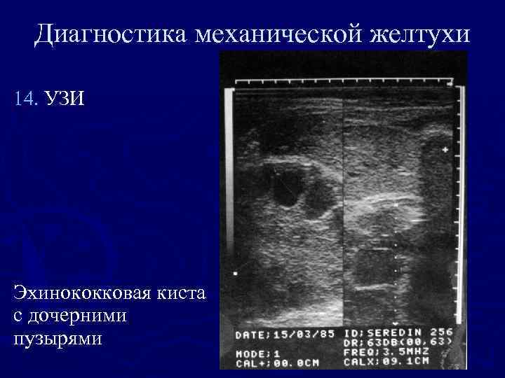 Диагностика механической желтухи 14. УЗИ Эхинококковая киста с дочерними пузырями 
